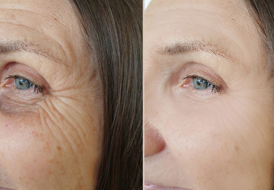 imagen ácido hialurónico en Valladoli